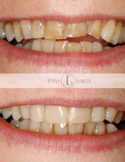 Close up showing before and after composite bonding treatment from Godmanchester Dental Huntingdon