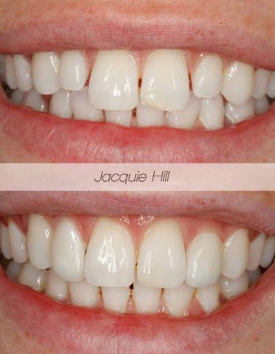 Close up of before and after composite bonding treatment from Godmanchester Dental Huntingdon