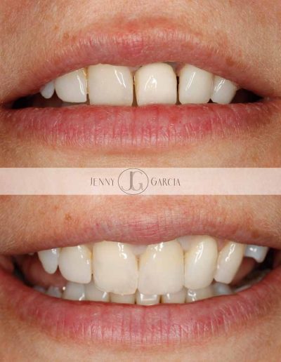Close up of before and after crown treatment at Godmanchester Dental Huntingdon