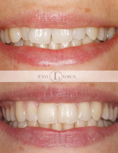 Close up of before and after Invisalign, invisible braces for straight teeth for a beautiful smile