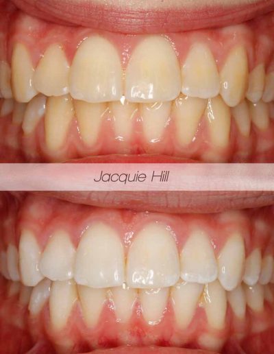 Close up of before and after Enlighten tooth whitening treatment Godmanchester Dental Huntingdon