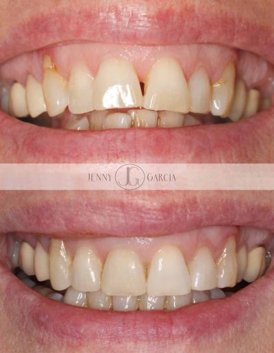 Close up of before and after Invisalign invisible braces for straight teeth