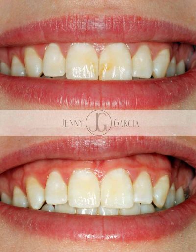 Close up of before and after tooth whitening and white spot removal at Godmanchester Dental Huntingdon