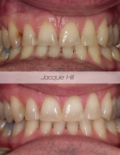 Close up of before and after tooth whitening treatment Godmanchester Dental Huntingdon
